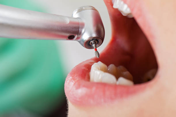 Best Emergency Wisdom Teeth Removal in Potomac Mills, VA